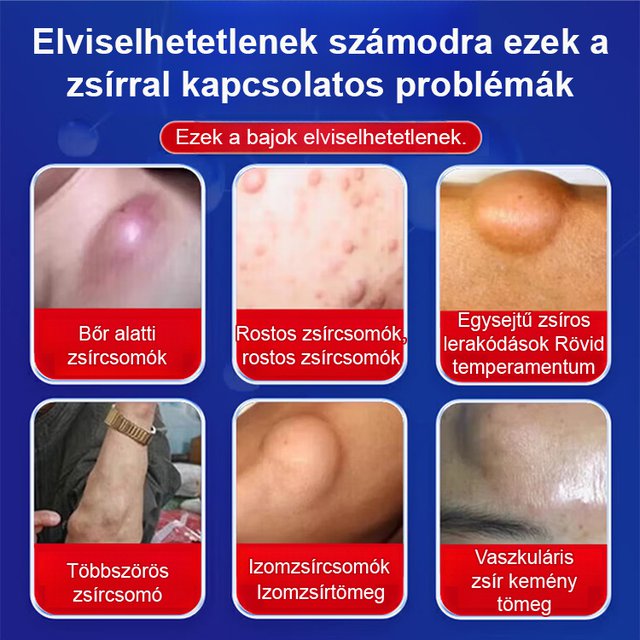 【Gyors hatású】Zsírkontroll kenőcs